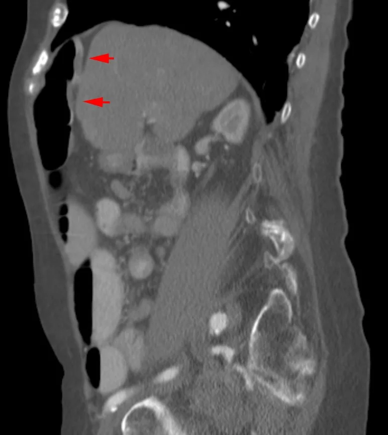 Chilaiditi işareti (psödo-pnömoperitoneum): yayımlanmış olgu görüntüsü, sagittal kesit