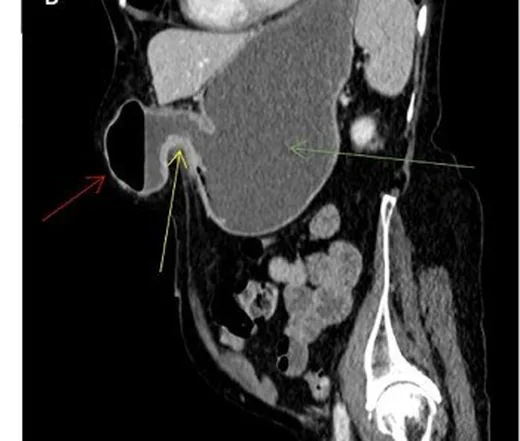 Epigastrik herni: yayımlanmış olgu görüntüsü, aksiyel kesit