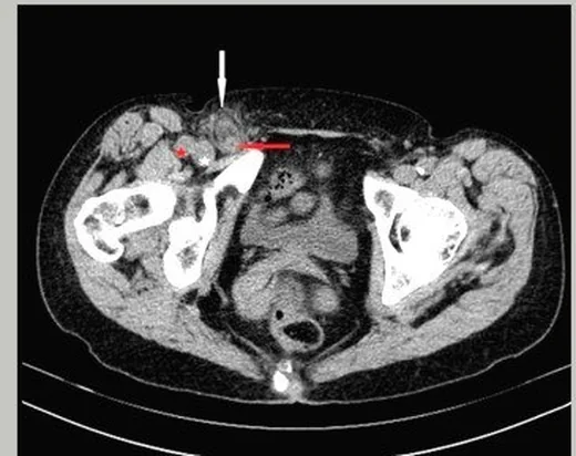 Femoral herni: yayımlanmış olgu görüntüsü, aksiyel kesit