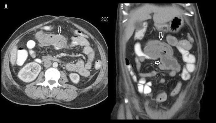 Retansiyone cerrahi materyal (gossypiboma): yayımlanmış olgu görüntüsü, aksiyel kesit