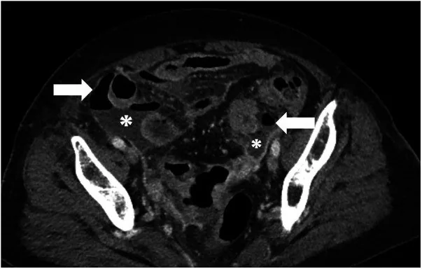 Peritoneal apse: yayımlanmış olgu görüntüsü, aksiyel kesit