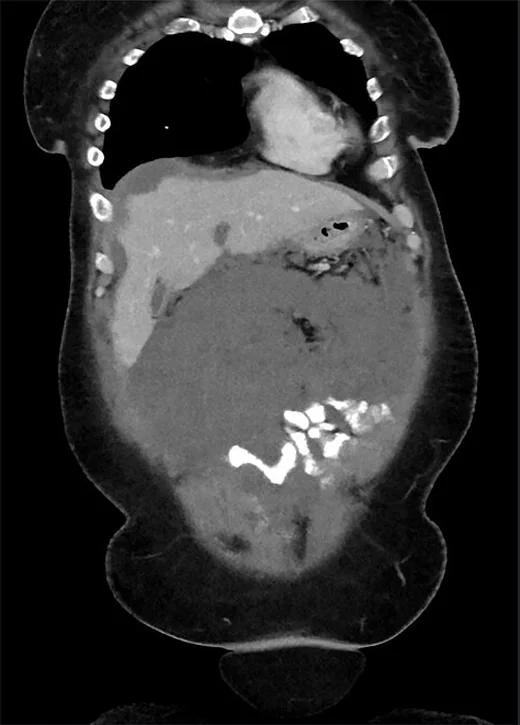 Peritoneal karsinomatozis: yayımlanmış olgu görüntüsü, koronal kesit