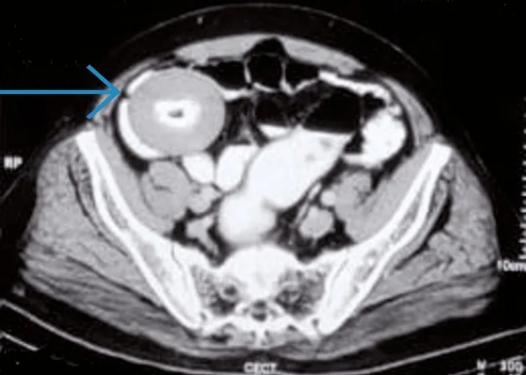 Peritoneal serbest cisim: yayımlanmış olgu görüntüsü, aksiyel kesit