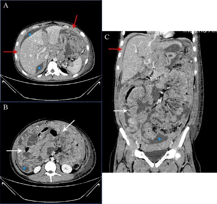 Peritoneal lenfomatozis: yayımlanmış olgu görüntüsü, aksiyel kesit