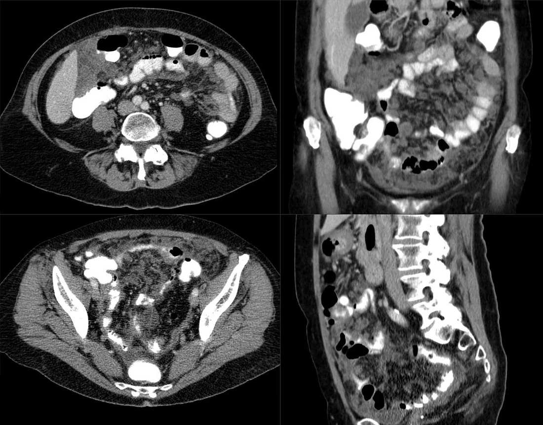 Peritoneal mezotelyoma: yayımlanmış olgu görüntüsü, aksiyel+koronal+sagittal kesit