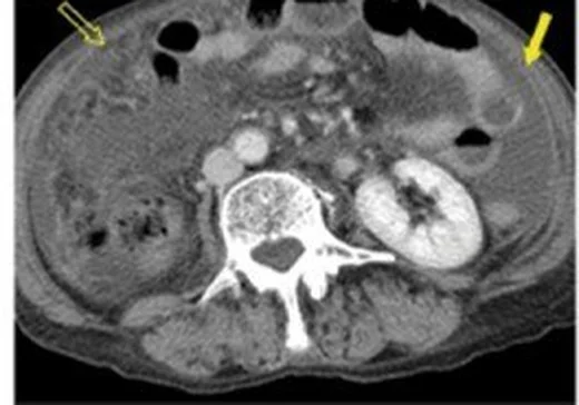 Peritoneal maligniteyi taklit eden benign/inflamatuvar hastalıklar: yayımlanmış olgu görüntüsü, aksiyel kesit