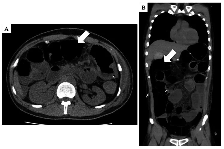 Postoperatif ileus ve mekanik tıkanma taklitçisi: yayımlanmış olgu görüntüsü, aksiyel ve koronal kesit