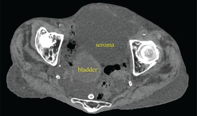 Postoperatif seroma: yayımlanmış olgu görüntüsü, aksiyel kesit