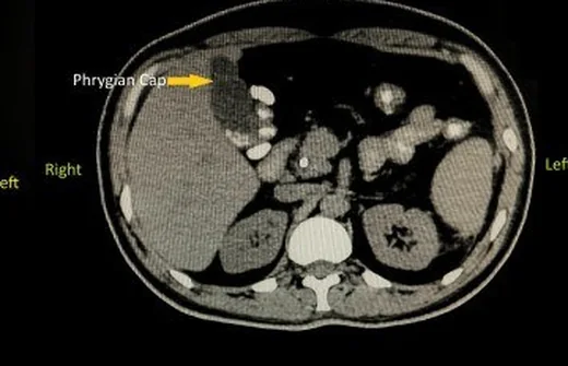 Fundus kıvrımı (Phrygian cap): yayımlanmış olgu görüntüsü, aksiyel kesit