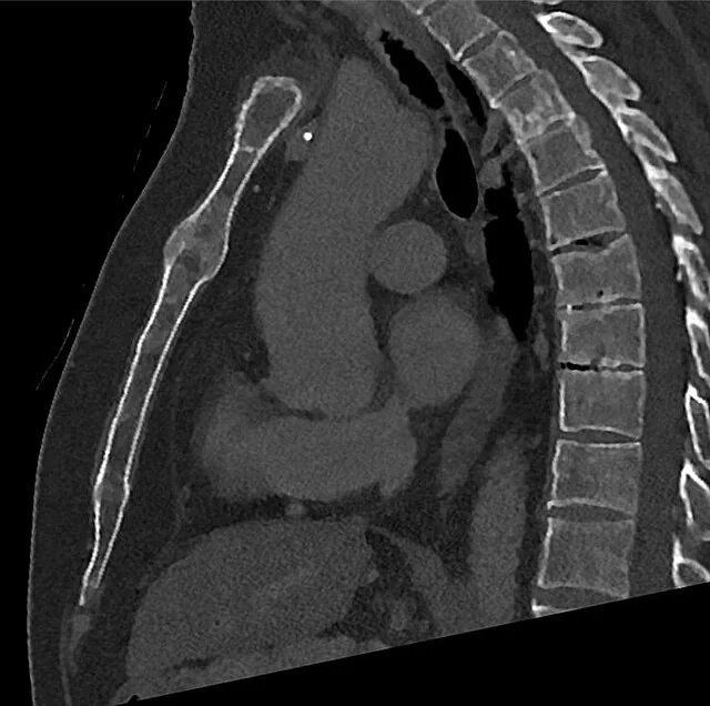 Sternum kırığı taklitçileri: yayımlanmış olgu görüntüsü, koronal+sagittal kesit