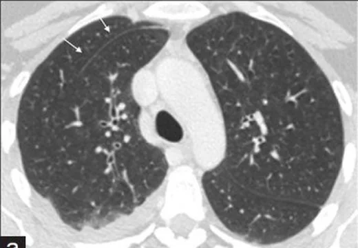Aksesuar pulmoner fissürler: yayımlanmış olgu görüntüsü, aksiyel kesit