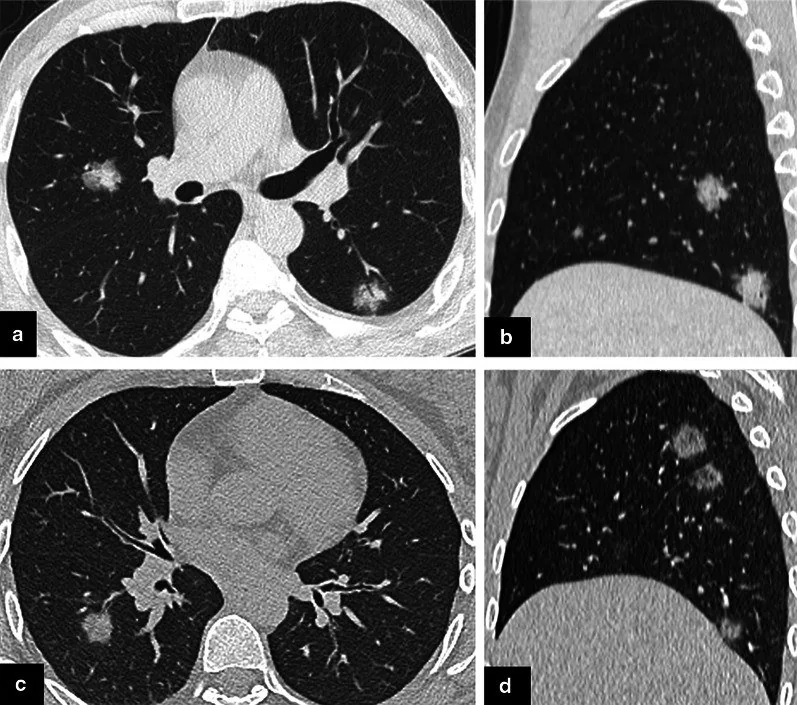 İnvaziv pulmoner aspergilloz: yayımlanmış olgu görüntüsü, aksiyel kesit