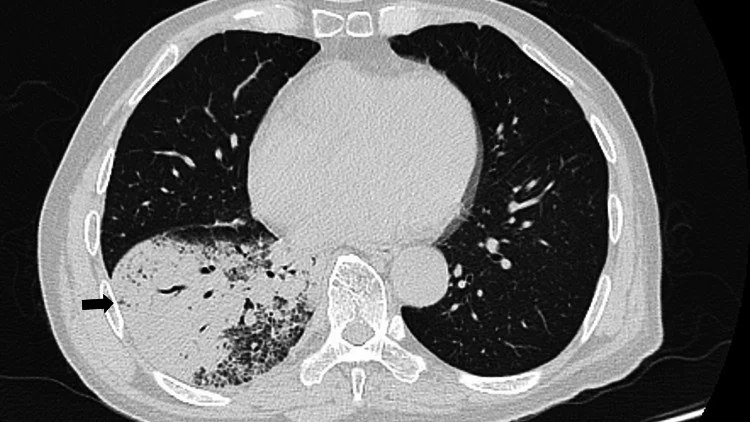 Legionella pnömonisi: yayımlanmış olgu görüntüsü, aksiyel kesit