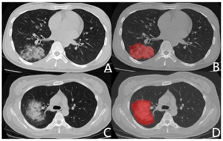 Mycoplasma pneumoniae pnömonisi: yayımlanmış olgu görüntüsü, aksiyel kesit