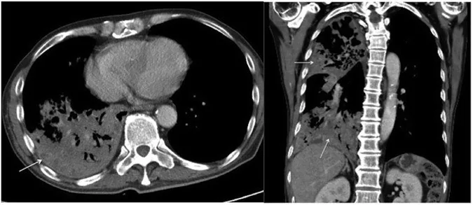 Primer pulmoner tüberküloz: yayımlanmış olgu görüntüsü, aksiyel kesit