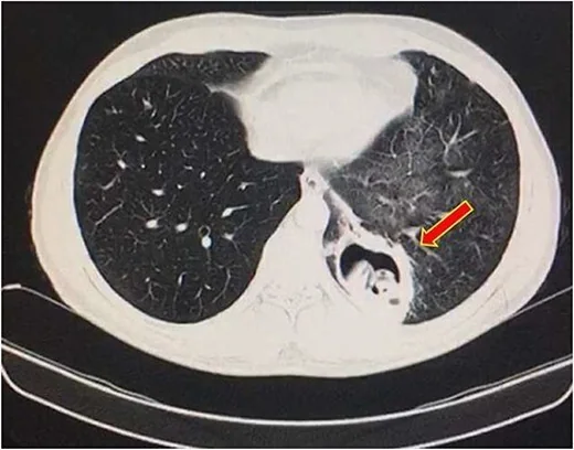 Pulmoner hidatik kist: yayımlanmış olgu görüntüsü, aksiyel kesit