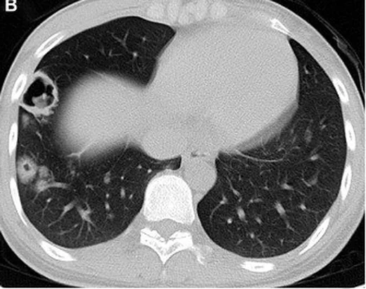 Pulmoner kriptokokkoz: yayımlanmış olgu görüntüsü, aksiyel kesit