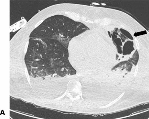 Pulmoner mukormikoz: yayımlanmış olgu görüntüsü, aksiyel kesit