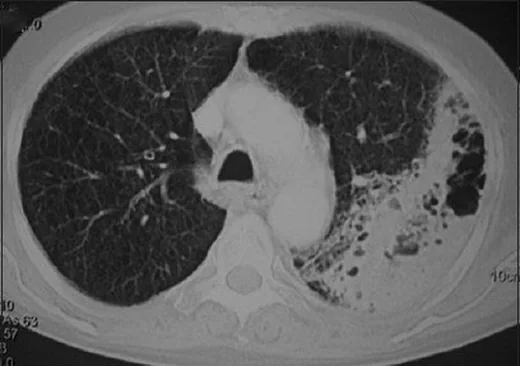 Pulmoner nokardiyoz: yayımlanmış olgu görüntüsü, aksiyel kesit