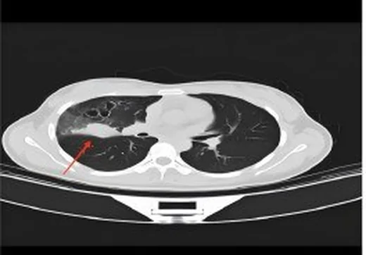 Pulmoner paragonimiyaz: yayımlanmış olgu görüntüsü, aksiyel kesit