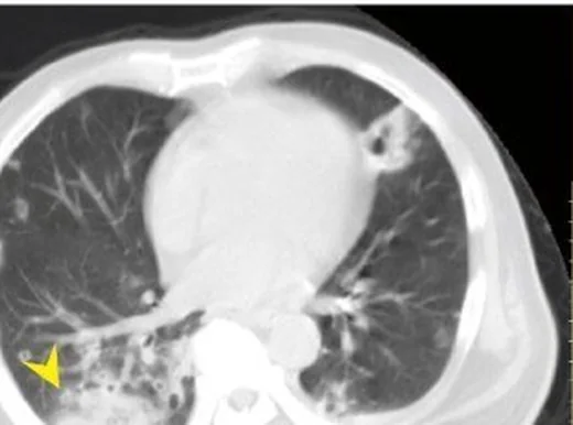Septik pulmoner emboliler: yayımlanmış olgu görüntüsü, aksiyel kesit