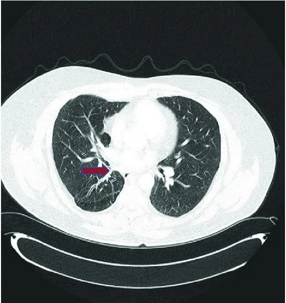 Endobronşiyal tümör: yayımlanmış olgu görüntüsü, aksiyel kesit