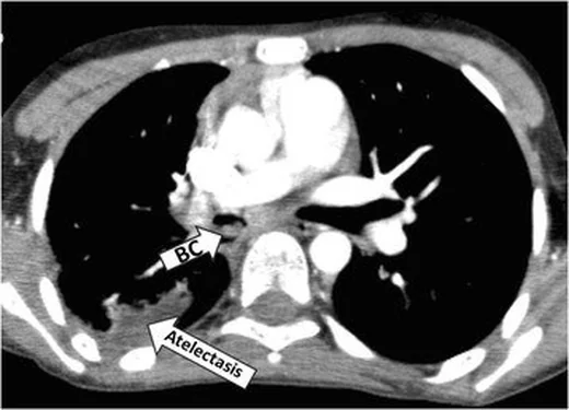 Endobronşiyal karsinoid: yayımlanmış olgu görüntüsü, aksiyel kesit