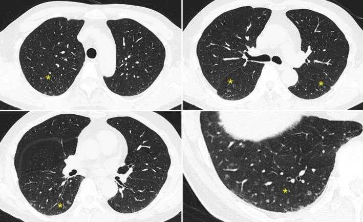 Diffüz pulmoner meningotelyomatozis: yayımlanmış olgu görüntüsü, aksiyel kesit
