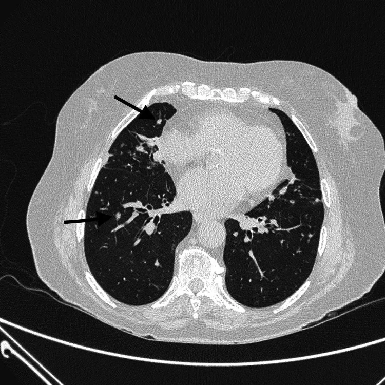 Diffüz idiyopatik pulmoner nöroendokrin hücre hiperplazisi: yayımlanmış olgu görüntüsü, aksiyel kesit