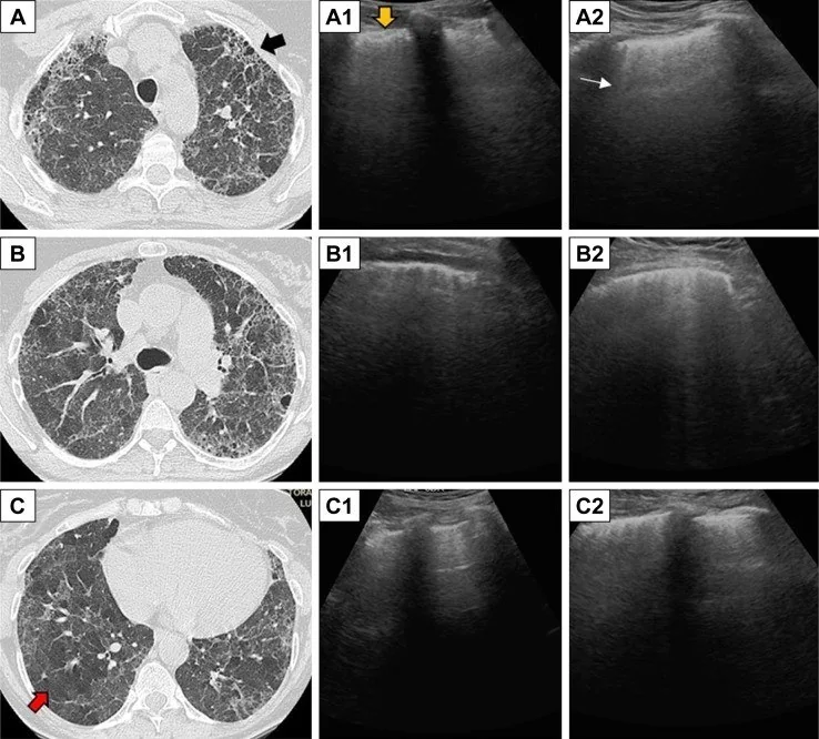 Fibrotik hipersensitivite pnömonisi: yayımlanmış olgu görüntüsü, aksiyel kesit