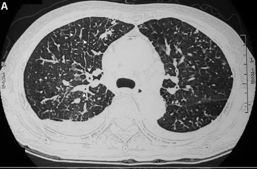 Pulmoner lenfanjitik karsinomatozis: yayımlanmış olgu görüntüsü, aksiyel kesit