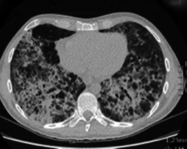 Pneumocystis jirovecii pnömonisi: diffüz buzlu cam taklitçisi: yayımlanmış olgu görüntüsü, aksiyel kesit