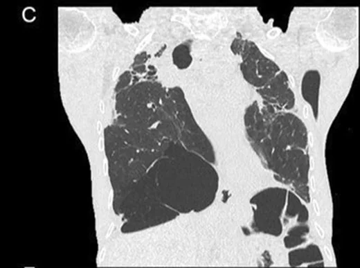 Pleuroparankimal fibroelastozis: yayımlanmış olgu görüntüsü, koronal kesit