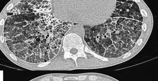 Pulmoner alveoler mikrolitiazis: yayımlanmış olgu görüntüsü, aksiyel kesit