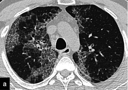 Pulmoner alveoler proteinozis: yayımlanmış olgu görüntüsü, aksiyel kesit