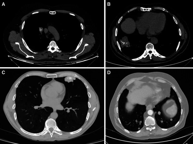 Pulmoner amiloidoz: yayımlanmış olgu görüntüsü, aksiyel kesit
