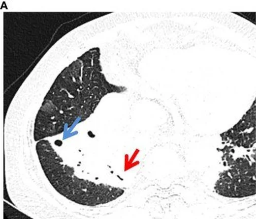 Pulmoner MALT lenfoması ve lenfoproliferatif taklitçi: yayımlanmış olgu görüntüsü, aksiyel kesit