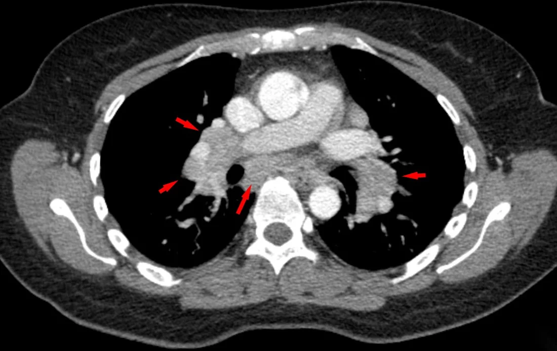 Pulmoner sarkoidoz: yayımlanmış olgu görüntüsü, aksiyel kesit