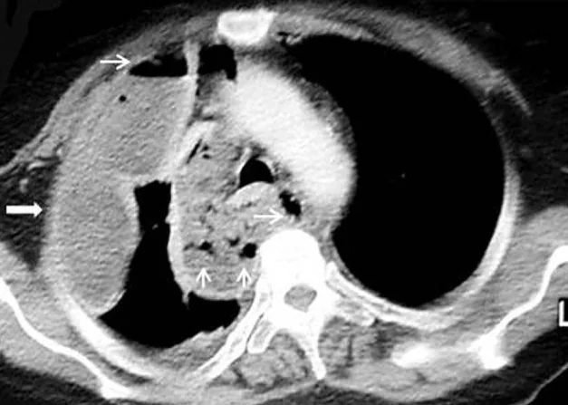 Akut mediastinit ve mediastinal apse: yayımlanmış olgu görüntüsü, aksiyel kesit