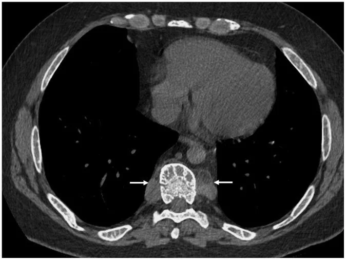 Mediastinal ekstramedüller hematopoez: yayımlanmış olgu görüntüsü, aksiyel kesit