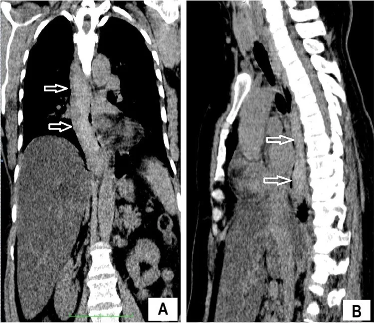 İntramural özofagus hematomu: yayımlanmış olgu görüntüsü, koronal+sagittal kesit