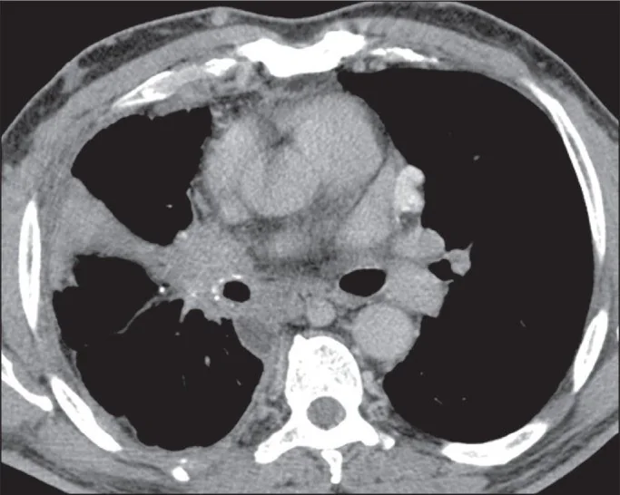 Fibrozan mediastinit: yayımlanmış olgu görüntüsü, aksiyel kesit