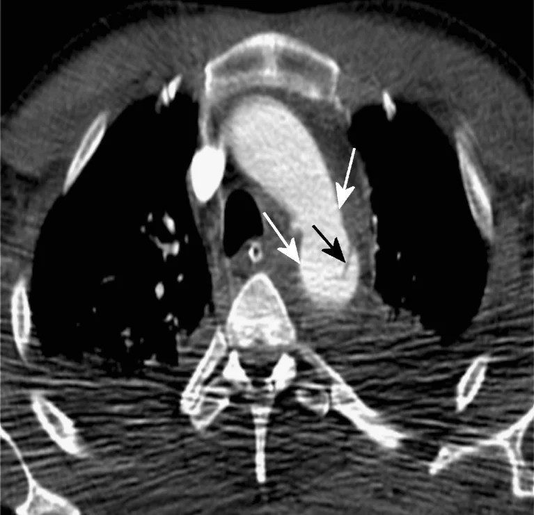 Mediastinal hematom: yayımlanmış olgu görüntüsü, aksiyel kesit