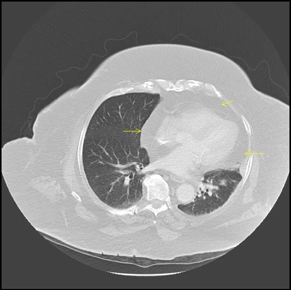 Mediastinal lipomatozis: yayımlanmış olgu görüntüsü, aksiyel kesit