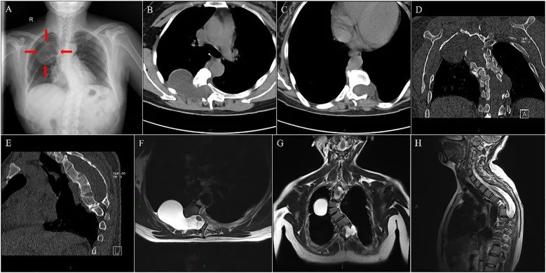Mediastinal meningosel: yayımlanmış olgu görüntüsü, aksiyel kesit