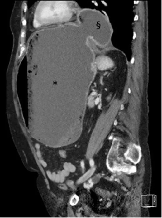 Hiatal herniye eşlik eden mide volvulusu: yayımlanmış olgu görüntüsü, sagittal kesit
