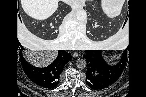 Paravertebral (arka) mediastinal kitle: yayımlanmış olgu görüntüsü, aksiyel kesit