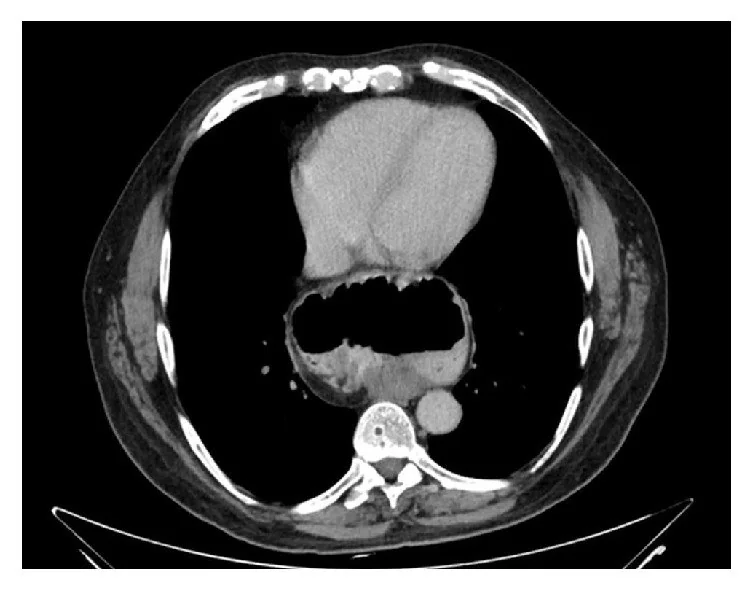 Paraözofageal hiatal herni (tip II–IV): yayımlanmış olgu görüntüsü, aksiyel kesit