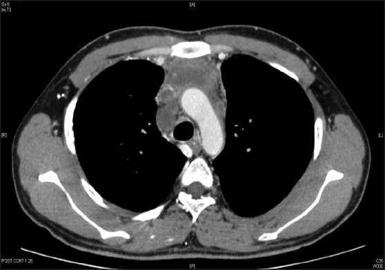 Mediastinal seminom: yayımlanmış olgu görüntüsü, aksiyel kesit