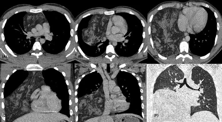 Timolipom ve mediastinal lipom: yayımlanmış olgu görüntüsü, aksiyel kesit